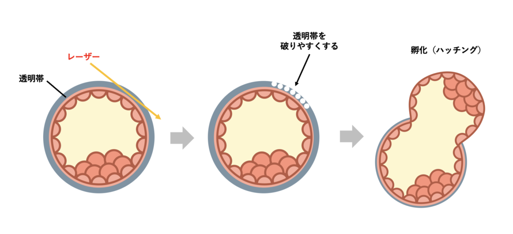 【体外受精オプション】レーザーアシステッドハッチングについて